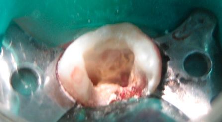 Endodoncia sin magnificación