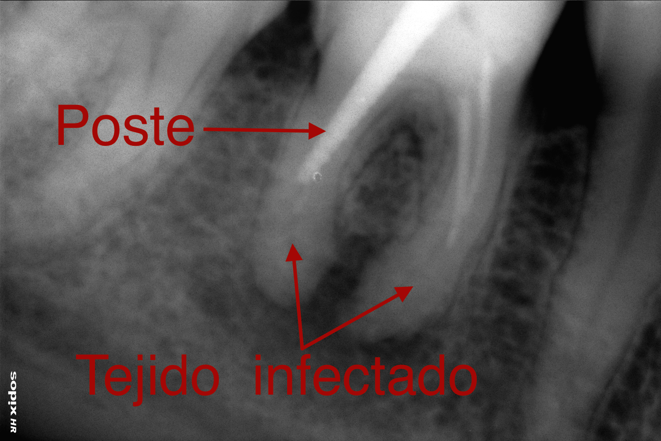 Endodoncia deficiente