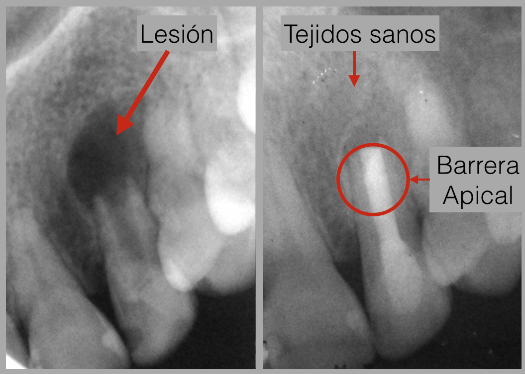 Barrera Apical en diente inmaduro y curación d los tejidos que rodean al diente