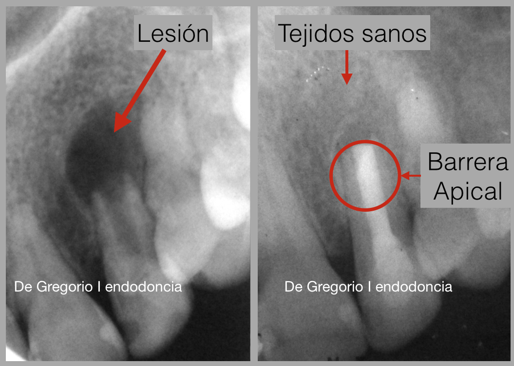 Barrera Apical en diente inmaduro y curación de los tejidos que rodean al diente