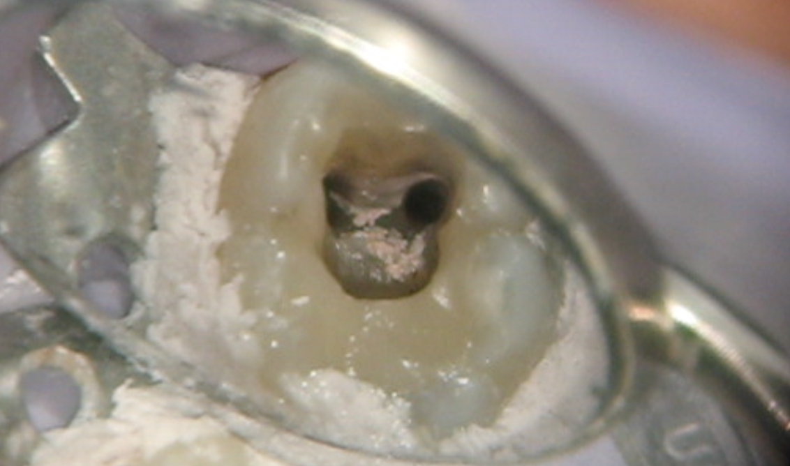 Endodoncia con Microscopio